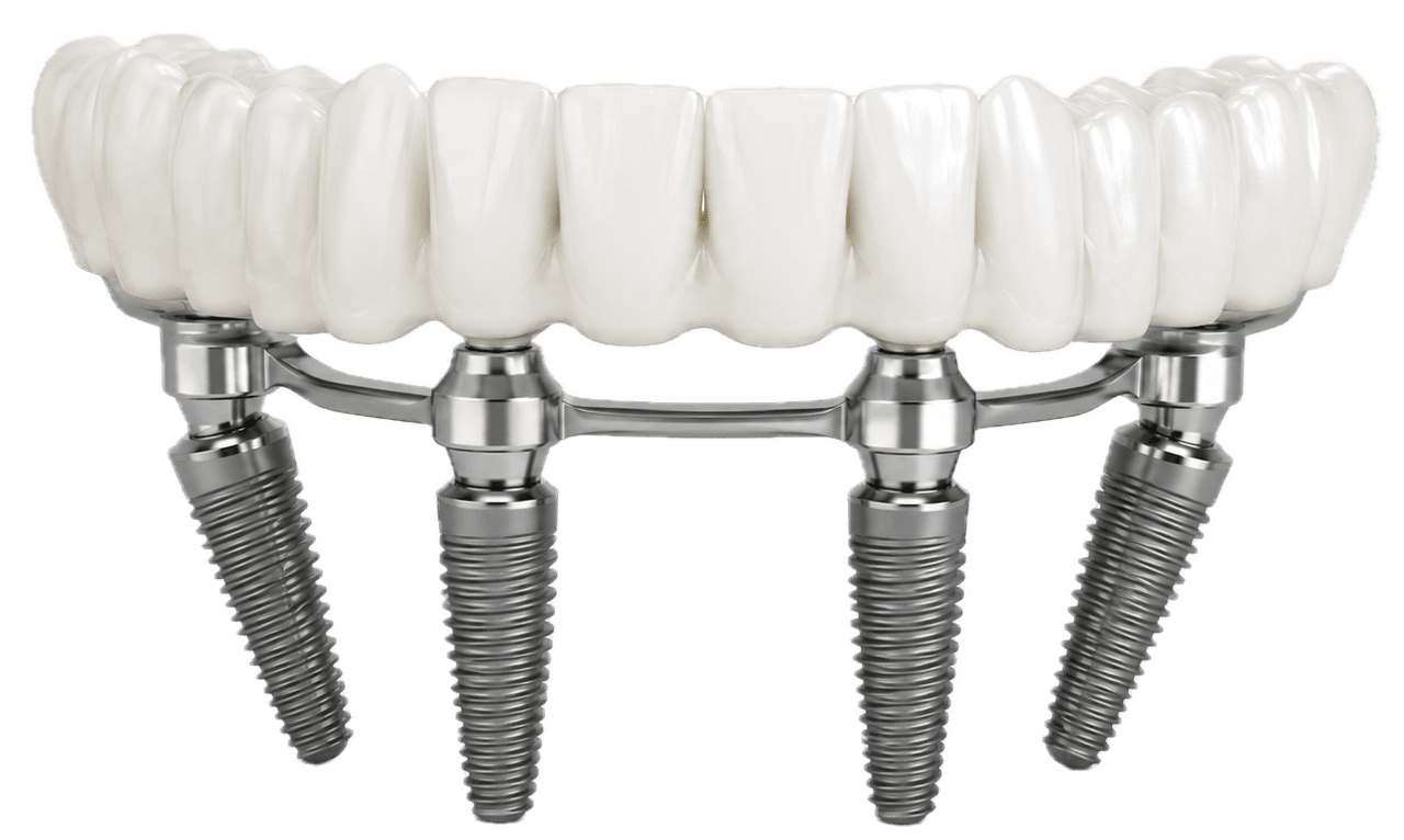 All-on-4 restoration — fixed arch supported by four implants